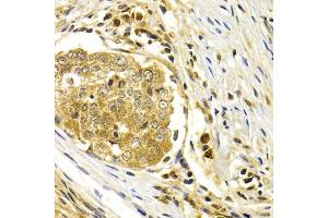 Immunohistochemistry of paraffin-embedded human esophageal cancer using CDK7 antibody (ABIN5970847) at dilution of 1/200 (40x lens).