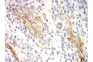 Immunohistochemical analysis of paraffin-embedded esophageal cancer tissues using KRT10 mouse mAb with DAB staining. (Keratin 10 anticorps  (AA 345-454))