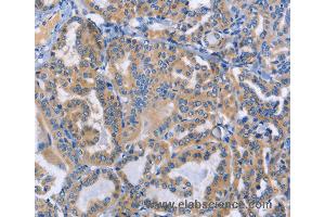 Immunohistochemistry of Human cervical cancer using DOK4 Polyclonal Antibody at dilution of 1:50 (DOK4 anticorps)