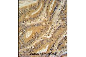 GNAT3 antibody immunohistochemistry analysis in formalin fixed and paraffin embedded human colon carcinoma followed by peroxidase conjugation of the secondary antibody and DAB staining. (GNAT3 anticorps  (AA 78-105))