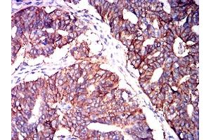 Immunohistochemical analysis of paraffin-embedded ovarian cancer tissues using CD147 mouse mAb with DAB staining.