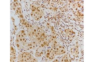 ABIN6256185 and ABIN6267192 at 1/100 staining Human breast cancer tissue by IHC-P.