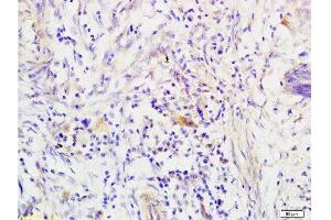 Formalin-fixed and paraffin embedded human colon carcinoma tissue labeled with Anti-RRM1 Polyclonal Antibody, Unconjugated  at 1:200 followed by conjugation to the secondary antibody, (SP-0023), and DAB staining (RRM1 anticorps  (AA 733-778))
