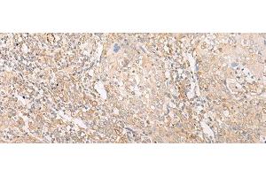 Immunohistochemistry of paraffin-embedded Human cervical cancer tissue using EPS15 Polyclonal Antibody at dilution of 1:50(x200)