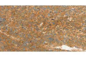 Immunohistochemistry of paraffin-embedded Human liver cancer using APOL2 Polyclonal Antibody at dilution of 1:80