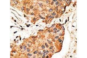 IHC analysis of FFPE human breast carcinoma tissue stained with the NRG1 antibody (Neuregulin 1 anticorps  (AA 198-229))