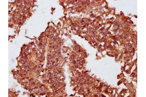 IHC image of ABIN7162115 diluted at 1:100 and staining in paraffin-embedded human cervical cancer performed on a Leica BondTM system.