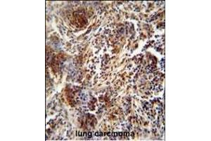 ZNF30 antibody (N-term) (ABIN654563 and ABIN2844269) immunohistochemistry analysis in formalin fixed and paraffin embedded human lung carcinoma followed by peroxidase conjugation of the secondary antibody and DAB staining. (ZFP30 anticorps  (N-Term))