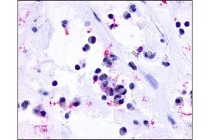 IHC staining of Nasal Mucosa (Allergic Rhinitis Eosinophils) using CysLT1 antibody ABIN122043. (CysLTR1 anticorps  (3rd Extracellular Domain))
