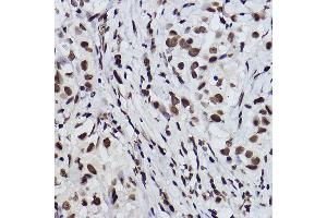 Immunohistochemistry of paraffin-embedded human breast cancer using Acetyl-Histone H3-K27 Rabbit mAb (ABIN3016650, ABIN3016651, ABIN3016652, ABIN1682513 and ABIN1682514) at dilution of 1:100 (40x lens).
