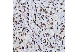 Immunohistochemistry of paraffin-embedded human breast cancer using Acetyl-Histone H3-K27 Rabbit mAb (ABIN3016650, ABIN3016651, ABIN3016652, ABIN1682513 and ABIN1682514) at dilution of 1:100 (40x lens). (Histone H3 (Acetyl K27) (acLys27) anticorps)