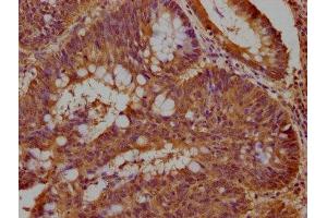 IHC image of ABIN7140086 diluted at 1:100 and staining in paraffin-embedded human colon cancer performed on a Leica BondTM system.