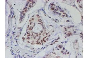 Immunohistochemical staining of paraffin-embedded Carcinoma of Human pancreas tissue using anti-TDO2 mouse monoclonal antibody. (TDO2 anticorps)