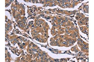The image on the left is immunohistochemistry of paraffin-embedded Human breast cancer tissue using ABIN7190535(EGR4 Antibody) at dilution 1/20, on the right is treated with synthetic peptide. (EGR4 anticorps)