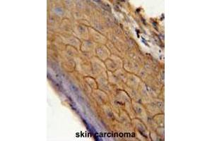 CB2 antibody (C-term) immunohistochemistry analysis in formalin fixed and paraffin embedded human skin carcinoma followed by peroxidase conjugation of the secondary antibody and DAB staining.