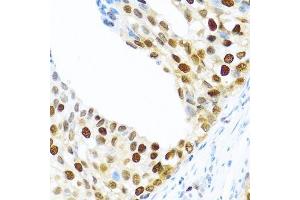 Immunohistochemistry of paraffin-embedded human prostate cancer using KHDRBS2 antibody. (KHDRBS2 anticorps  (C-Term))