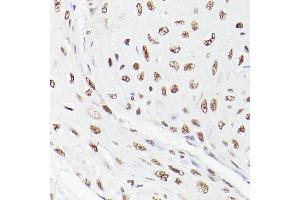 Immunohistochemistry of paraffin-embedded human esophageal cancer using LEO1 Rabbit pAb (ABIN6133790, ABIN6143141 and ABIN7101832) at dilution of 1:100 (40x lens). (LEO1 anticorps)