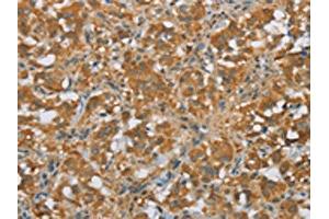 The image on the left is immunohistochemistry of paraffin-embedded Human thyroid cancer tissue using ABIN7190675(FOXB1 Antibody) at dilution 1/30, on the right is treated with synthetic peptide. (FOXB1 anticorps)