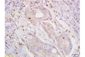 Formalin-fixed and paraffin embedded human lung carcinoma labeled with Rabbit Anti CXorf36 Polyclonal Antibody, Unconjugated  at 1:200 followed by conjugation to the secondary antibody and DAB staining (CXORF36 anticorps  (AA 91-182))