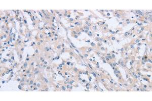 Immunohistochemistry of paraffin-embedded Human thyroid cancer tissue using AGAP2 Polyclonal Antibody at dilution 1:60 (AGAP2 anticorps)