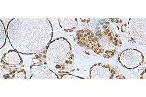 Immunohistochemistry of paraffin-embedded Human thyroid cancer tissue using PTPA Polyclonal Antibody at dilution of 1:50(x200) (PPP2R4 anticorps)