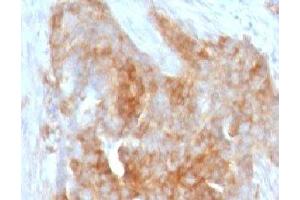 IHC testing of FFPE human ovarian carcinoma with Fascin antibody (clone FAN55-1) (Fascin anticorps)