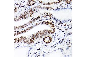 Immunohistochemistry of paraffin-embedded human colon carcinoma using MCM2 Rabbit mAb (ABIN7268538) at dilution of 1:100 (40x lens). (MCM2 anticorps)