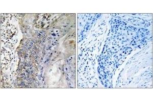 Immunohistochemistry analysis of paraffin-embedded human lung carcinoma tissue, using SLC28A2 Antibody. (SLC28A2 anticorps  (AA 371-420))