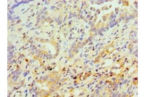 Immunohistochemistry of paraffin-embedded human lung cancer using ABIN7158299 at dilution of 1:100 (CD43 anticorps  (AA 276-400))