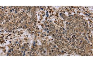 Immunohistochemistry of paraffin-embedded Human liver cancer tissue using NLRP4 Polyclonal Antibody at dilution 1:40 (NLRP4 anticorps)