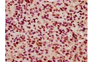 IHC image of ABIN7157651 diluted at 1:600 and staining in paraffin-embedded human glioma performed on a Leica BondTM system.