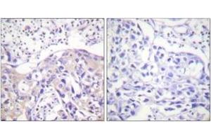Immunohistochemistry analysis of paraffin-embedded human breast carcinoma, using ADD1 (Phospho-Thr445) Antibody. (alpha Adducin anticorps  (pThr445))