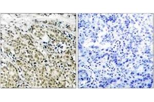 Immunohistochemistry analysis of paraffin-embedded human prostate carcinoma, using Androgen Receptor (Ab-213) Antibody. (Androgen Receptor anticorps  (AA 186-235))