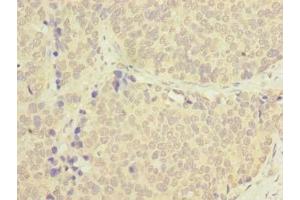 Immunohistochemistry of paraffin-embedded human gastric cancer using ABIN7173631 at dilution of 1:100 (TSACC/C1orf182 anticorps  (AA 1-125))