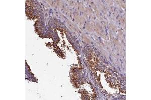 Immunohistochemical staining of human prostate with CLN5 polyclonal antibody  shows strong cytoplasmic positivity in glandular cells. (CLN5 anticorps)
