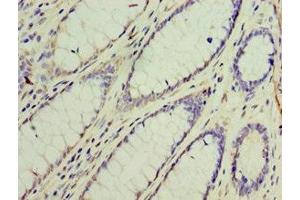 Immunohistochemistry of paraffin-embedded human colon cancer using ABIN7154312 at dilution of 1:100
