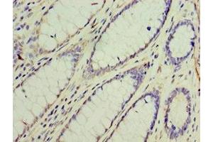 Immunohistochemistry of paraffin-embedded human colon cancer using ABIN7154312 at dilution of 1:100 (GS28 anticorps  (AA 1-115))