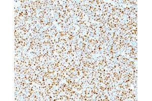 IHC testing of human mantle cell lymphoma stained with Cyclin D1 antibody. (Cyclin D1 anticorps)