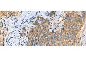 Immunohistochemistry of paraffin-embedded Human cervical cancer tissue using PSMA6 Polyclonal Antibody at dilution of 1:90(x200)