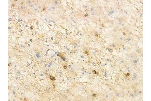 ABIN6261315 and ABIN6266717 at 1/100 staining human astrocytoma by IHC-P. (DLX3 anticorps  (Internal Region))