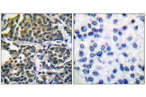 Immunohistochemical analysis of paraffin-embedded human breast carcinoma tissue using HSP90B (epitope around residue 254) antibody (ABIN5976154).