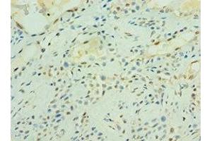 Immunohistochemistry of paraffin-embedded human breast cancer using ABIN7166484 at dilution of 1:100 (MAS1 anticorps  (AA 246-325))