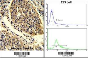 (LEFT)Formalin-fixed and paraffin-embedded human lung carcinoma reacted with WNT4 Antibody (C-term), which was peroxidase-conjugated to the secondary antibody, followed by DAB staining. (WNT4 anticorps  (C-Term))