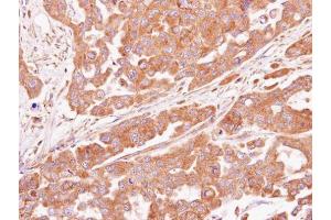 IHC-P Image Immunohistochemical analysis of paraffin-embedded OVCAR3 xenograft, using ASB4, antibody at 1:100 dilution. (ASB4 anticorps)