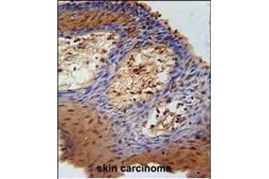 DHRS2 Antibody (C-term) (ABIN651532 and ABIN2840282) immunohistochemistry analysis in formalin fixed and paraffin embedded human skin carcinoma followed by peroxidase conjugation of the secondary antibody and DAB staining. (DHRS2 anticorps  (C-Term))