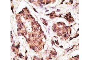 IHC analysis of FFPE human breast carcinoma tissue stained with the PGP9.