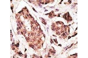 IHC analysis of FFPE human breast carcinoma tissue stained with the PGP9. (UCHL1 anticorps  (AA 187-216))