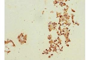 Immunohistochemistry of paraffin-embedded human breast cancer using ABIN7150598 at dilution of 1:100