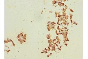 Immunohistochemistry of paraffin-embedded human breast cancer using ABIN7150598 at dilution of 1:100 (Ribophorin II anticorps  (AA 360-540))