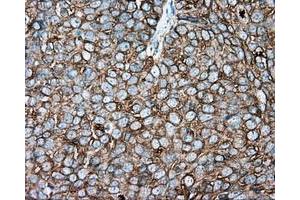 Immunohistochemical staining of paraffin-embedded Adenocarcinoma of colon tissue using anti-TUBA8 mouse monoclonal antibody.